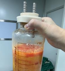 海安水动力吸脂手术要做多久？